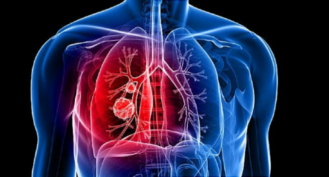 The Truth Behind Lung Cancer: a Reason to Quit Smoking